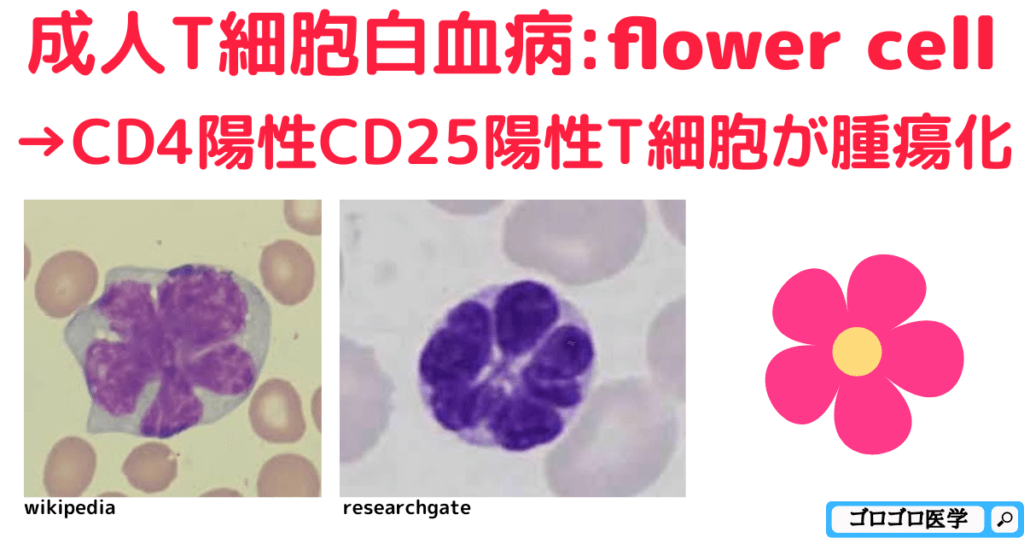【CD4/CD8比】なぜ成人T細胞白血病で上昇-AIDSで低下？覚え方・ゴロ：成人T細胞白血病リンパ腫の白血病細胞「flower cell」 →細胞表面マーカーのCD4陽性CD25陽性