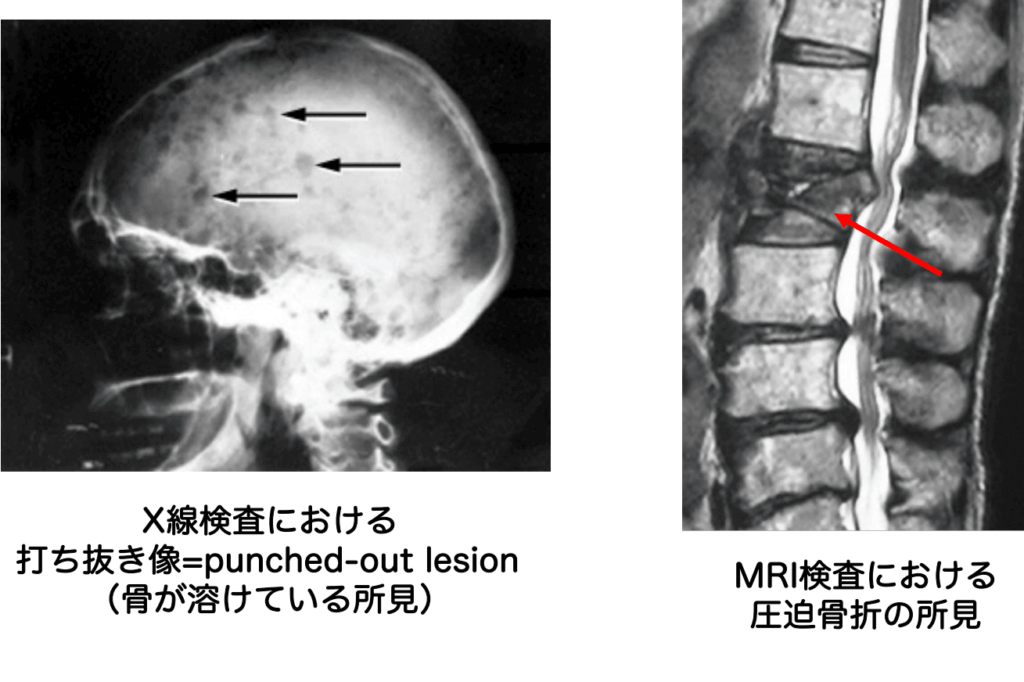 骨髄腫の予後はどのようなものですか?