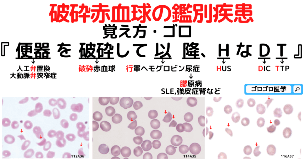 破砕赤血球とは？鑑別疾患の覚え方・ゴロ【CBT国試対策】