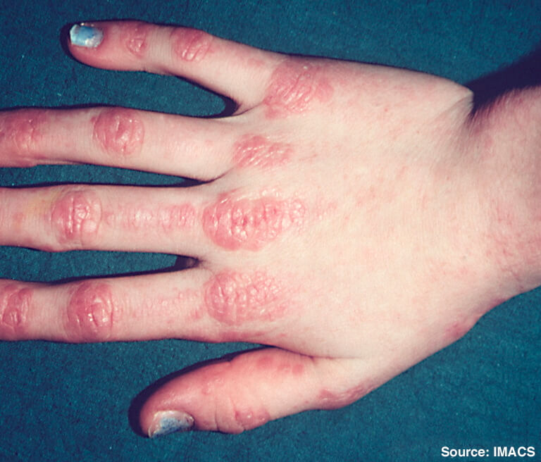 Gottron徴候（Gottron's papules）の典型像